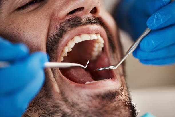 Best Emergency Dentist for Lost Fillings or Crowns in Cibecue, AZ